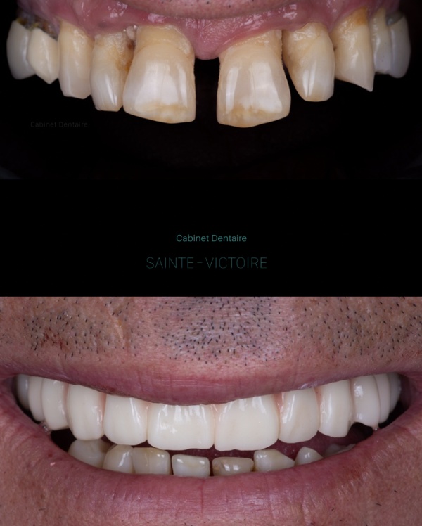 Implant dentaire et gencive